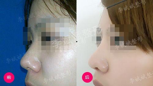 耳软骨隆鼻视频,视频解析与效果展示